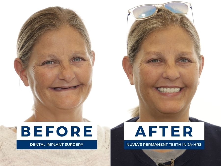 Woman smiling before and after getting dental implants