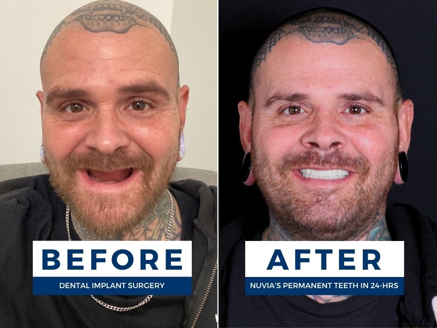 Man smiling before and after getting all-on-4 dental implants