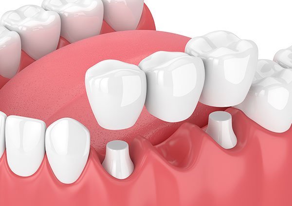 A graphical depiction of a dental bridge