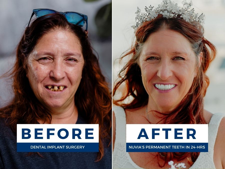Cassie smiling before and after getting new teeth at Nuvia