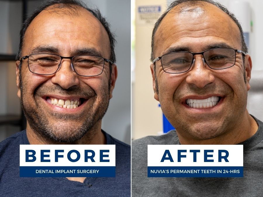 Man smiling before and after getting full mouth dental implants