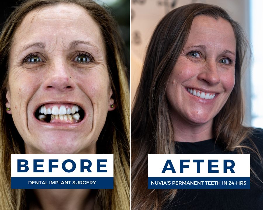 Michelle smiling before and after getting full mouth dental implants