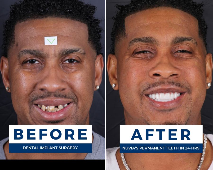 Rozay smiling before and after getting new teeth at Nuvia