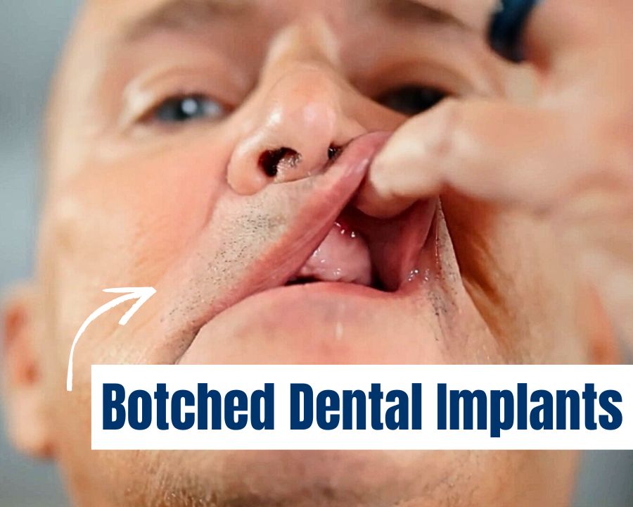 Close up of man pulling up lip to show failed dental implants and text that says "botched dental implants"