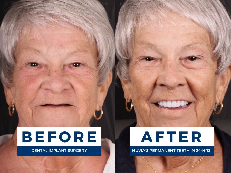 Older woman with no teeth before and after getting dental implants