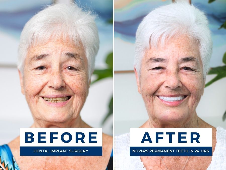 Smiling woman before and after getting dental implants