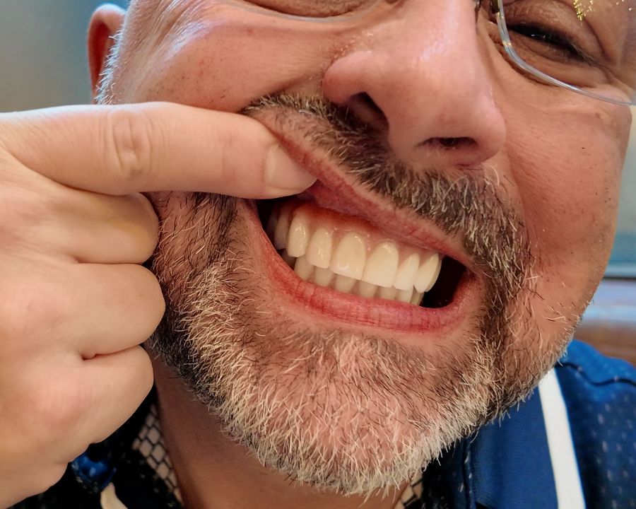 Randee pulling his lip back to show his new permanent teeth