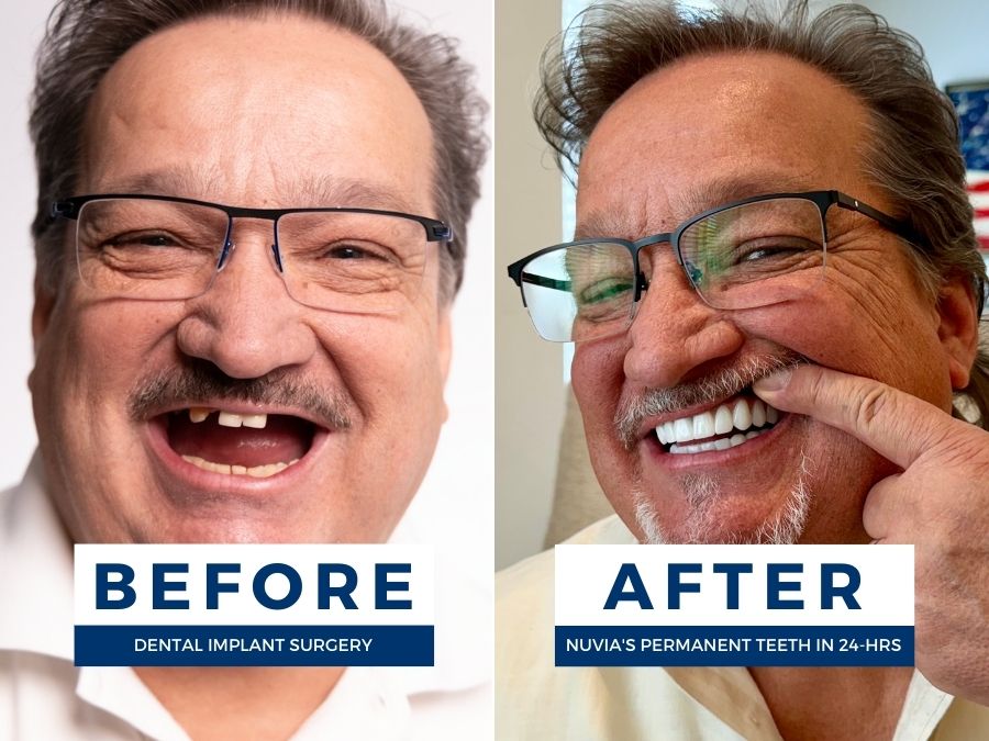 Man smiling before and after safely getting permanent teeth in 24 hours