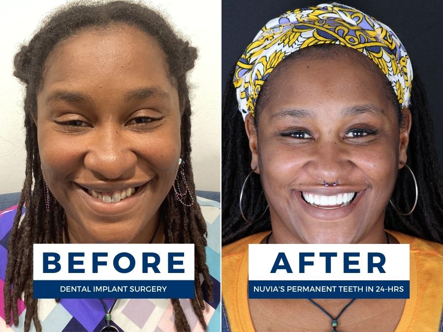 Woman smiling before and after getting safely done permanent teeth in 24 hours
