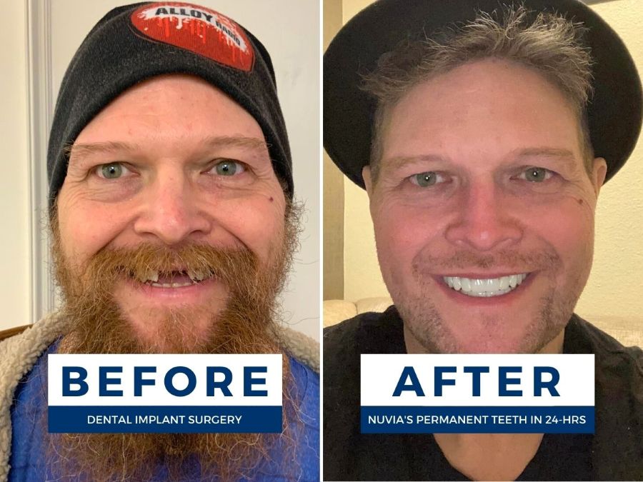 Ken smiling before and after living with dental implants