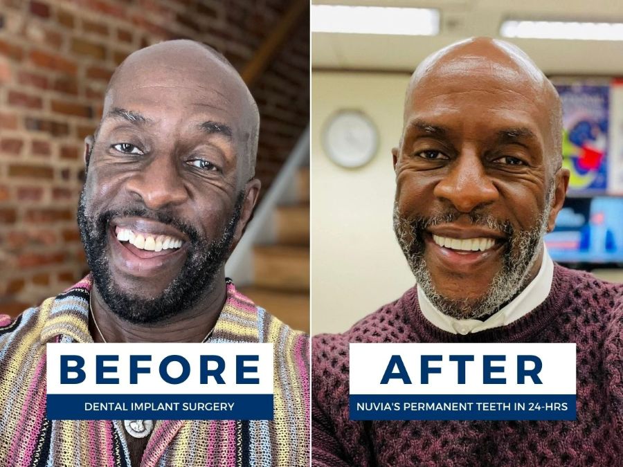 Alvin smiling before and after getting dental implants