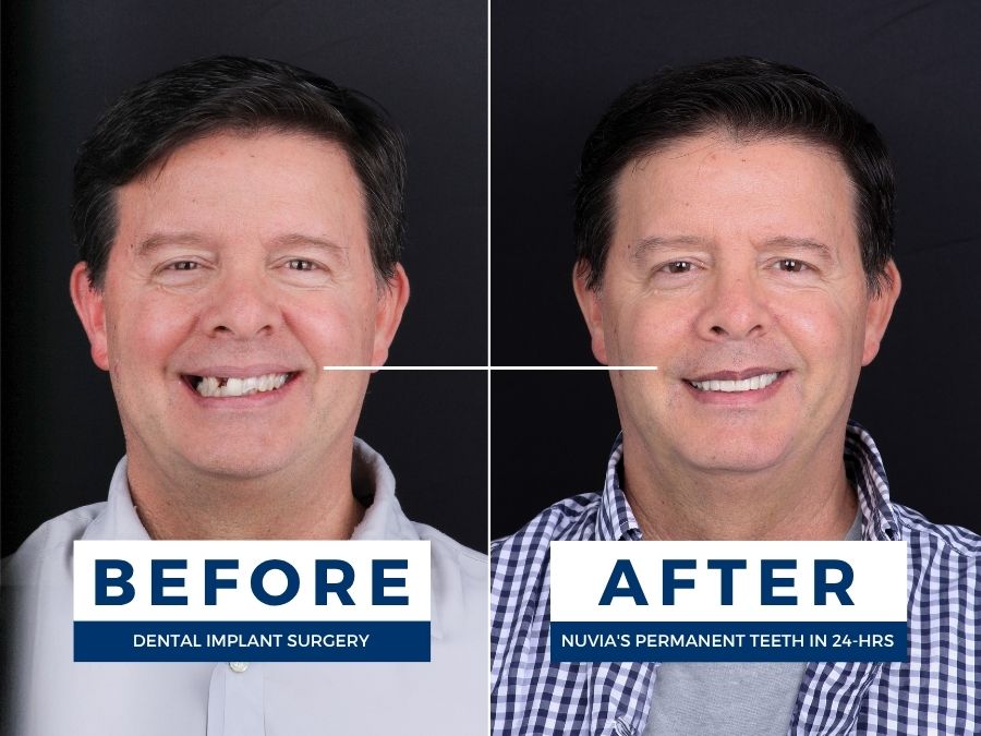 Javier smiling before and after getting dental implants in Miami