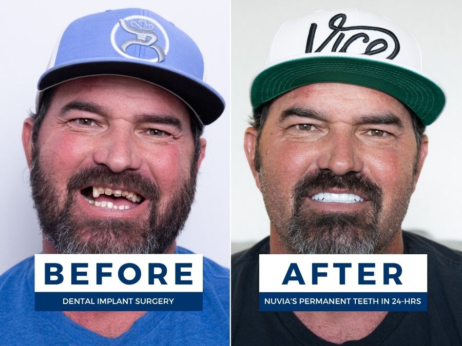 Salt Lake City Dental Implant Patient smiling before and after