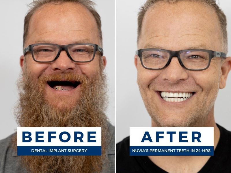 Man smiling before and after replacing missing teeth with dental implants
