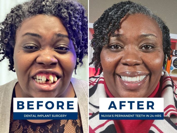 Sharala smiling before and after getting 24 hour dental implants
