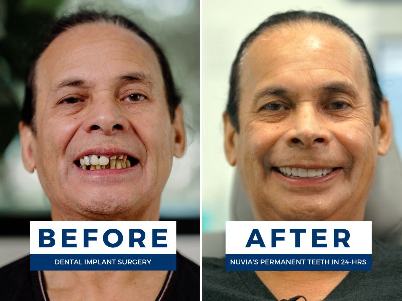 Pedro smiling with failed dental solutions from dental tourism next to an after photo when he got dental implants at Nuvia