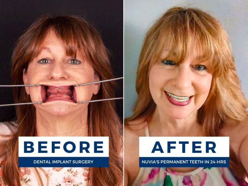 Diabetic woman smiling before and after getting dental implants