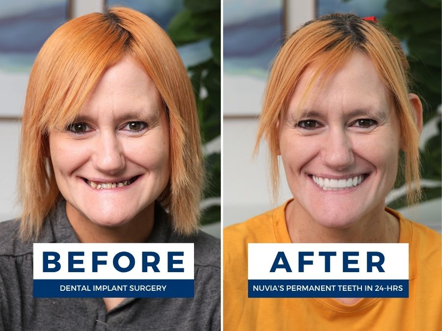 Woman smiling before and after financing dental implants