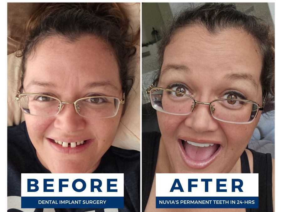 Woman smiling before and after getting her zirconia arch