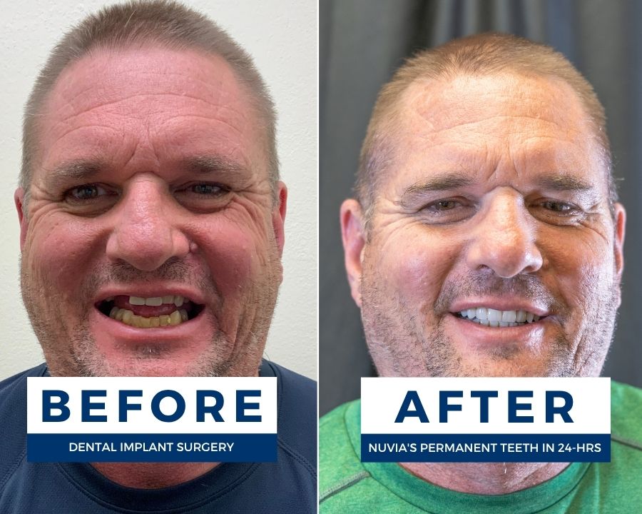 Man smiling before and after getting titanium dental implants and zirconia bridge