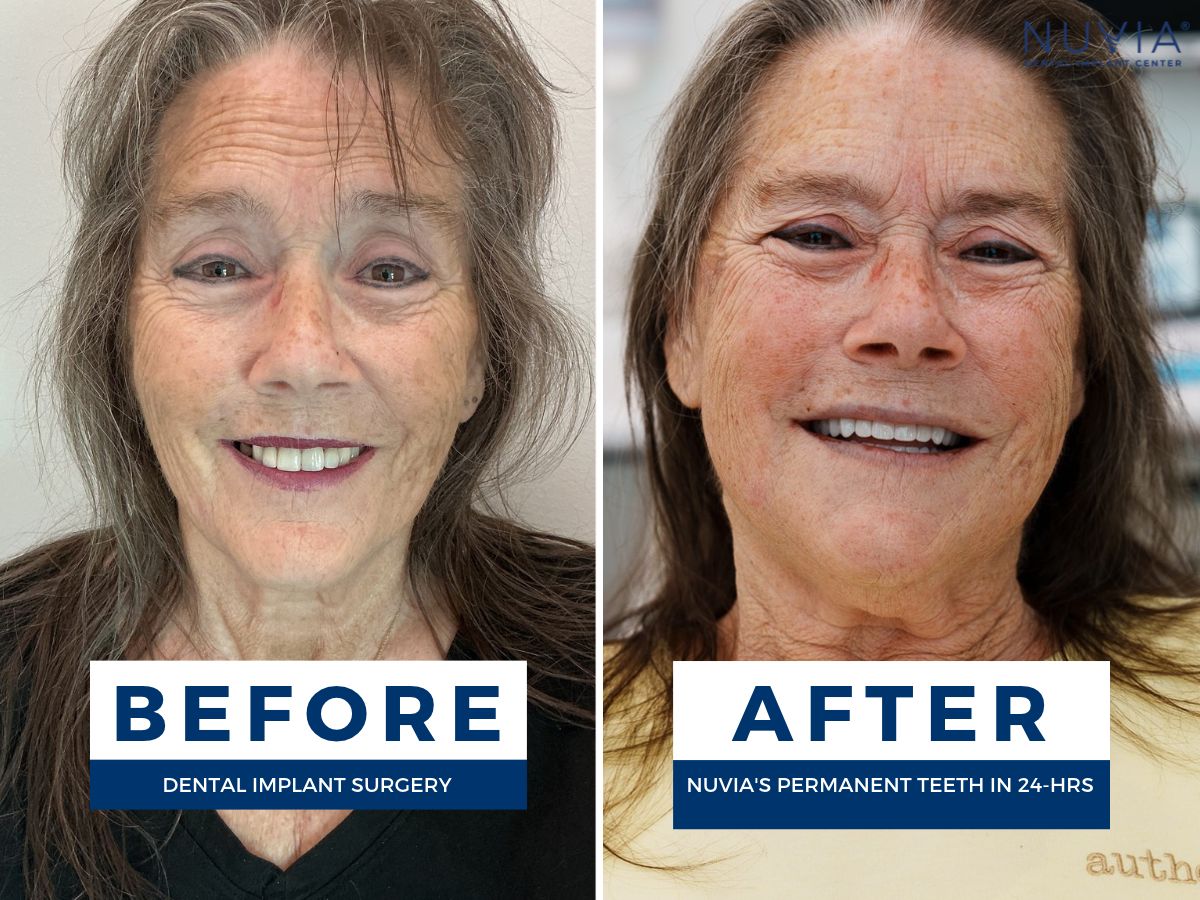 Dawn Haywood smiling before and after getting dental implants at Nuvia