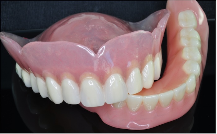 A set of dentures to illustrate the benefits of dentures and the drawbacks